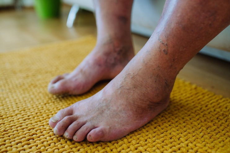 Leg Swelling