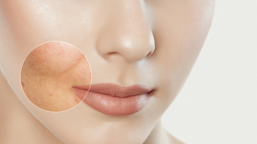 Pore-Shrinking 