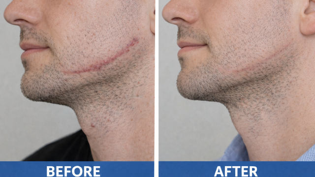 post acne before and after