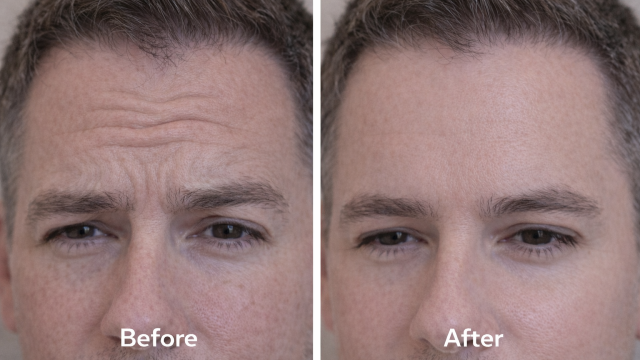 Expression Line before and after