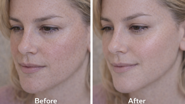 Facial Balance Pbefore and after