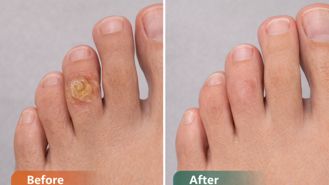 Painful Corn before-and-after