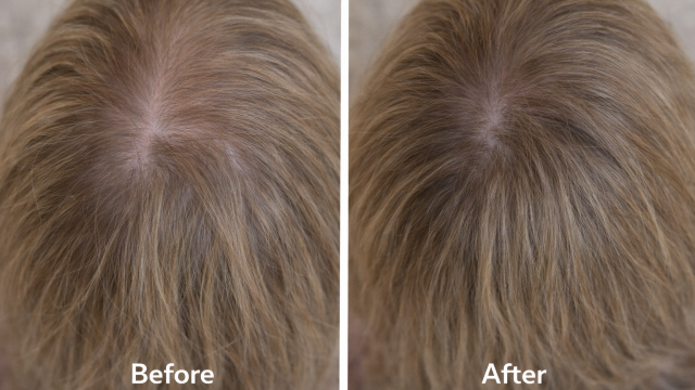 Crown Density Concern before and after