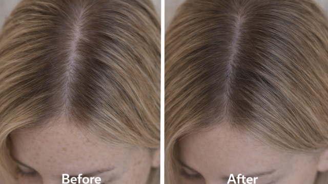 Hair Thinning Concern  before nad after