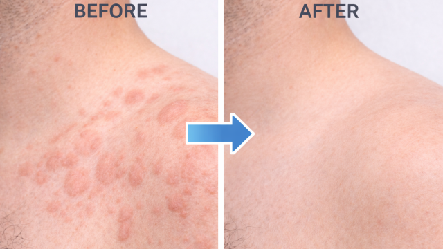 Chronic Hives before and after
