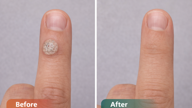 Persistent Wart  before and after