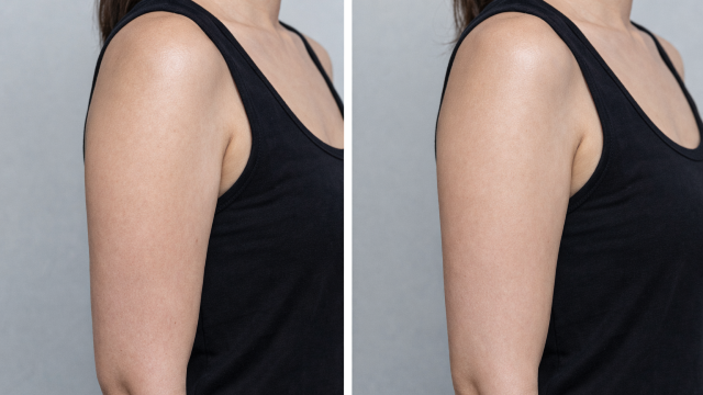 Upper Arm Contouring  before and after