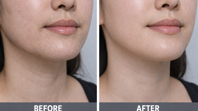 Facial Hair Removal before and after