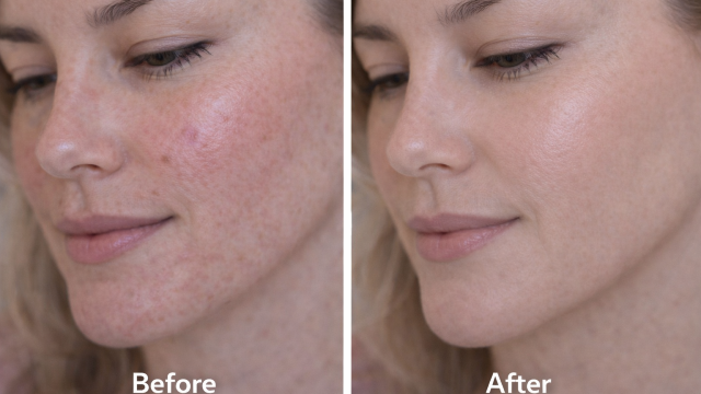 Sensitive Skin  before and after