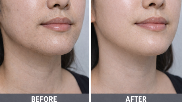 Skin and Vitality Improvement before and after