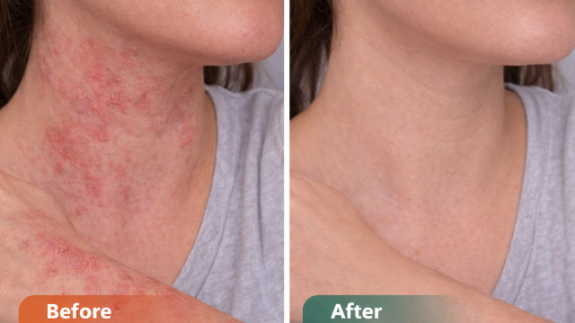 Chronic Eczema before and after