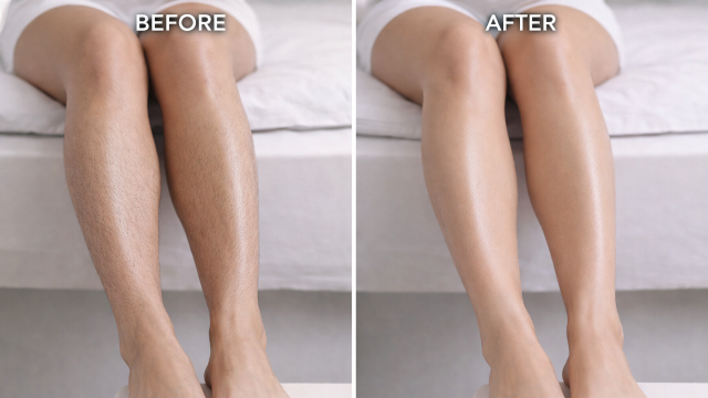 Leg Hair Removal before and after