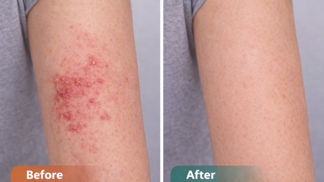 Allergy-Related Skin Irritation before and after