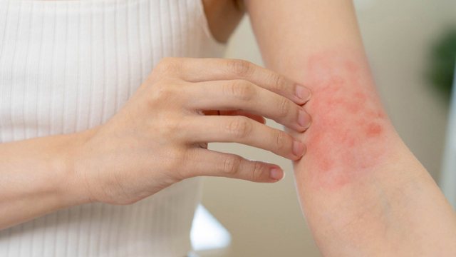 Atopic Dermatitis
