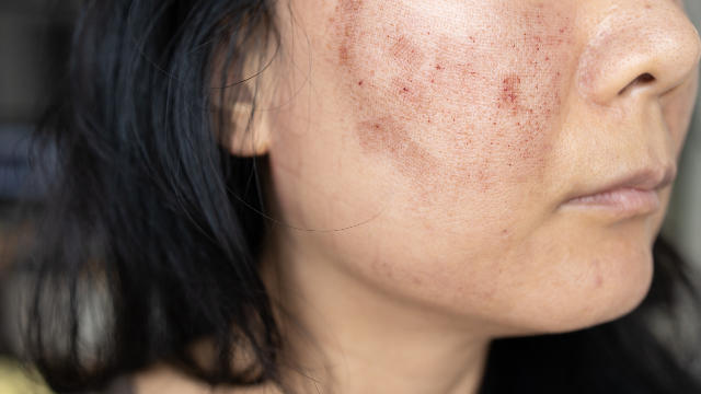 Pigmentation