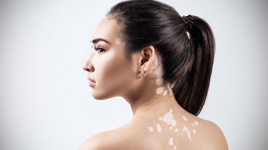 Pigmentation