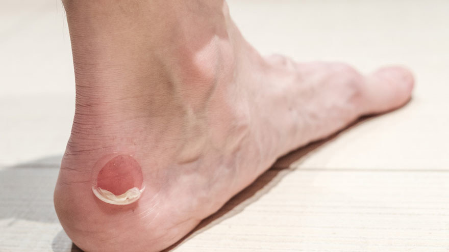 Corns and Warts