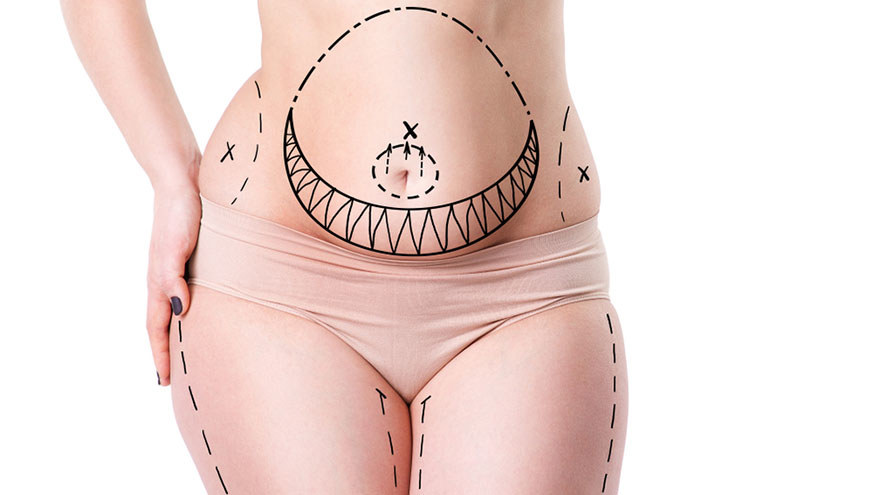 Belly Fat Removal