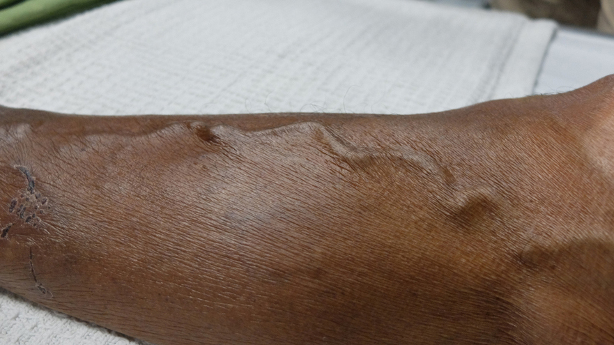 Varicose Vein Surgery