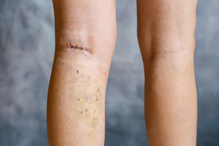 Vein Stripping Surgery
