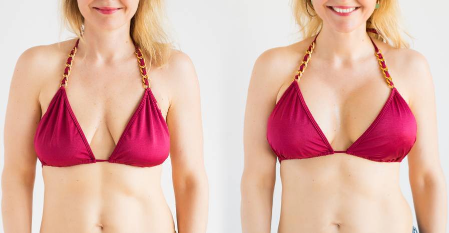 Breast Lift Surgery