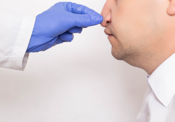The Rhinoplasty Procedure for Fixing a Hump Nose