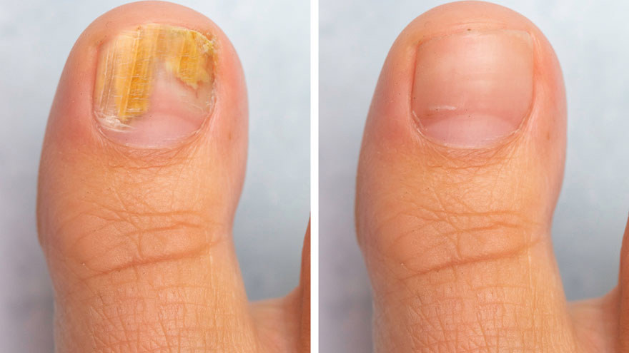 fungal infection is completely gone.