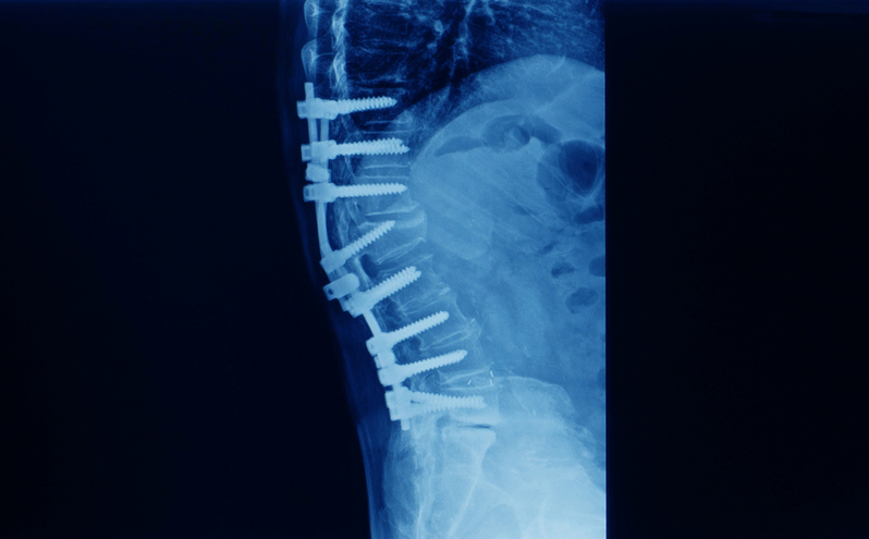 Spinal Stenosis