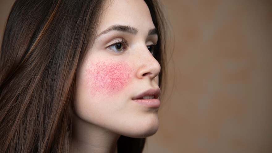 early rosacea