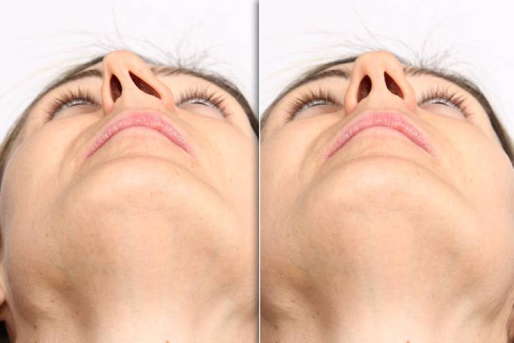 Results of Nostril Reduction Rhinoplasty
