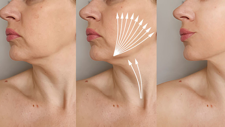 Thread Lift