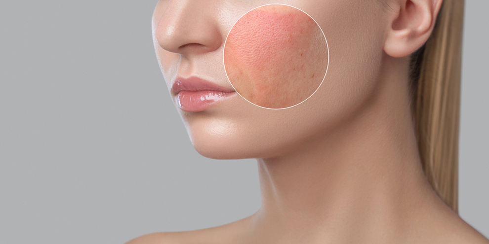 Acne Treatments
