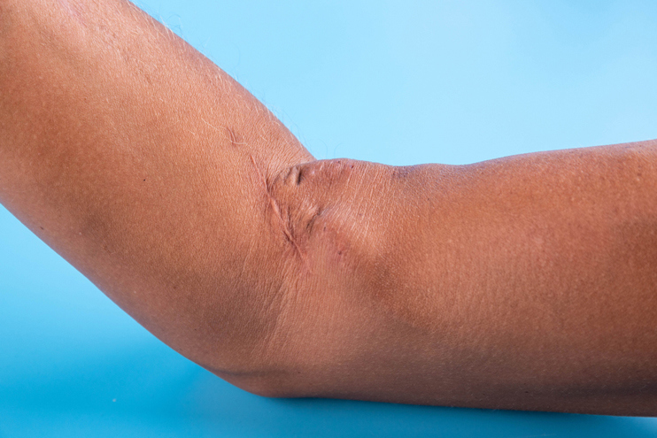 AV Fistula
