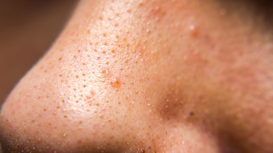 dirty skin
