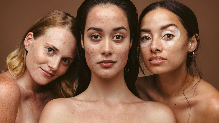 Skin Types