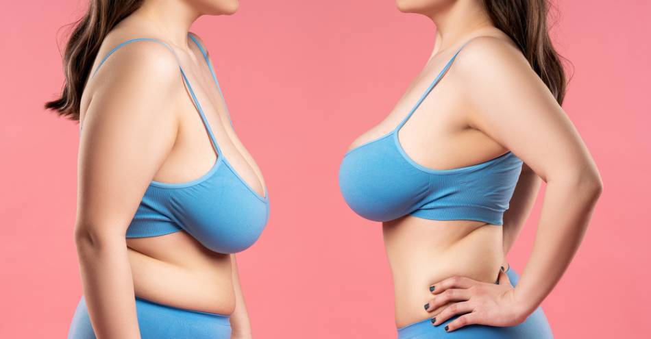 乳房下垂