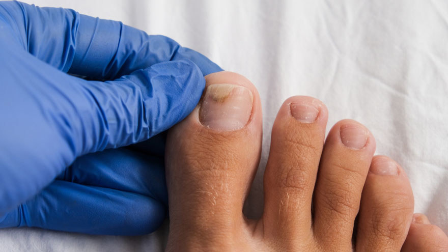 Treating Fungal Nail Infections