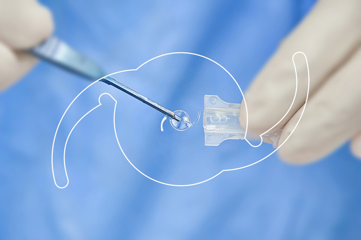 IOL Implants for Cataracts