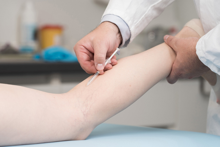 Sclerotherapy