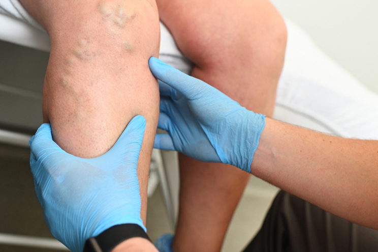Non-Surgical Varicose Vein Treatments