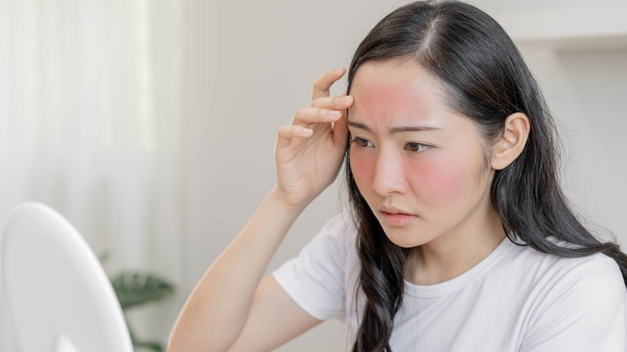 Skin Keeps Flushing