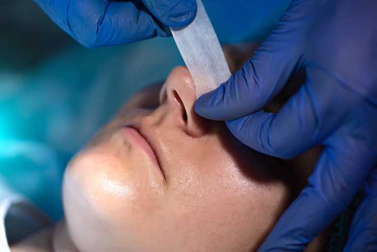 Rhinoplasty for Asymmetrical Nostrils
