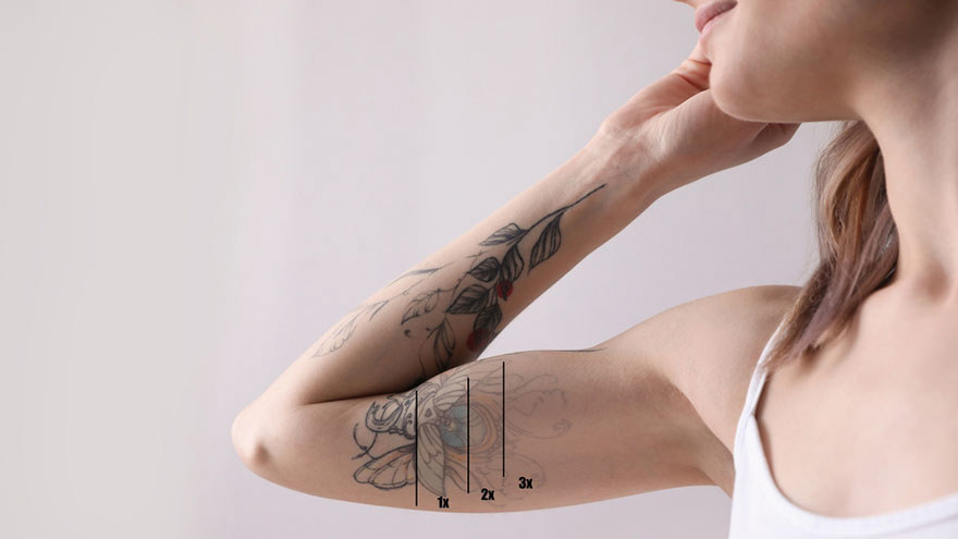 Laser Tattoo Removal