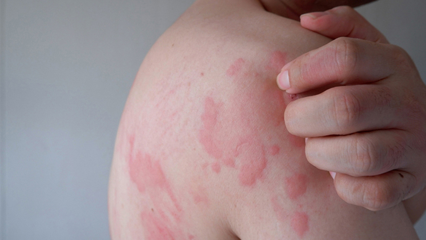 Allergy Severity