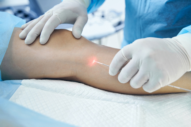 Laser Vein Treatment