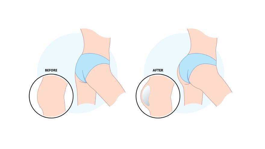 Silicone Hip Implants