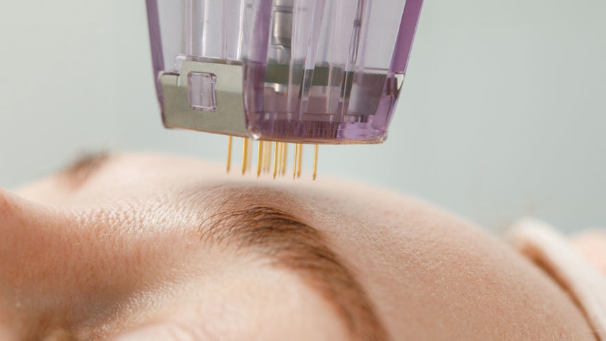 Microneedling