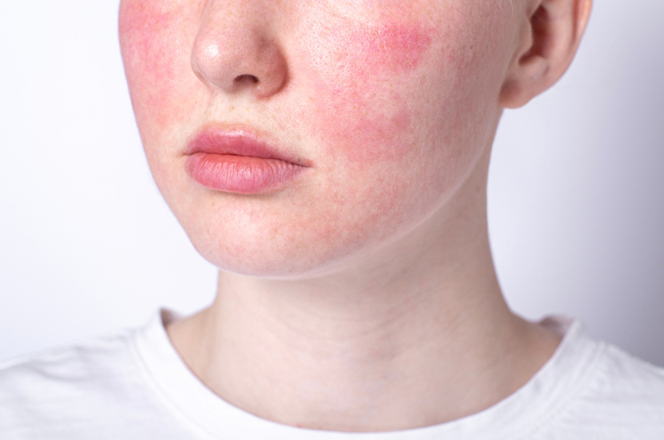 Skin Sensitivity