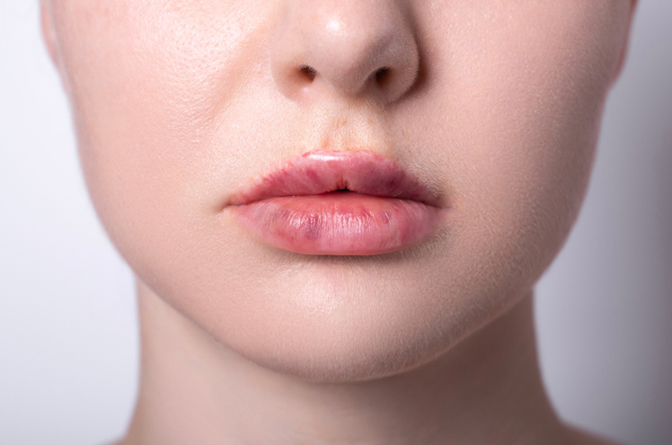 Overfilled Lips