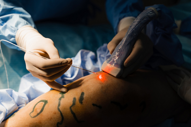 Laser Treatment for Varicose Veins